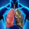 3 cách đơn giản phòng ngừa ung thư phổi